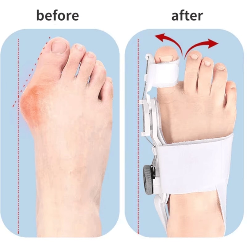 Bunion Corrector Brace with Rotatable Toe Separator